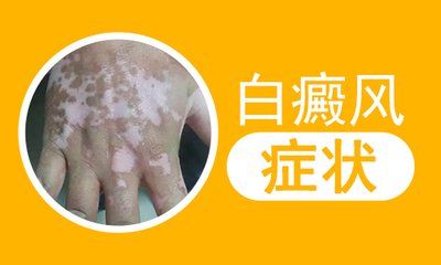 预防护理-五点帮你护理好白癜风